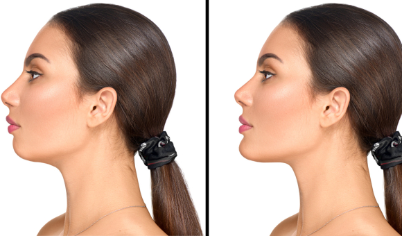 Before and after photo of a woman who underwent chin augmentation, showcasing a more defined and balanced profile