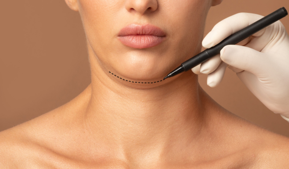 Close-up of a woman's chin with precise markings, preparing for a chin augmentation