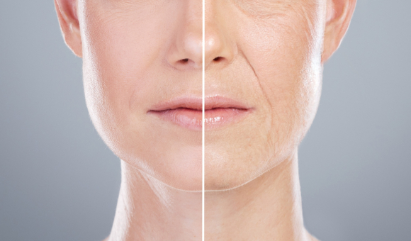 Before and after close-up of a woman's face, showing the transformation following a facelift