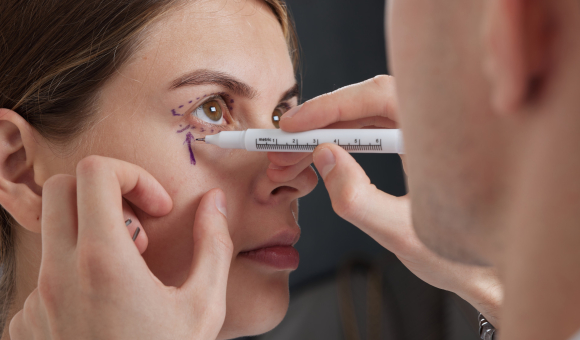 Close-up of a surgeon drawing precise lines on a woman's face, marking the areas for eye surgery