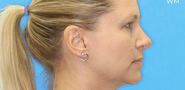 Rhinoplasty Patient 2 After