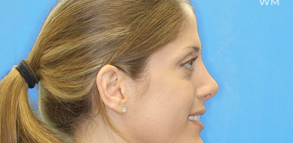 Rhinoplasty Patient 3 After