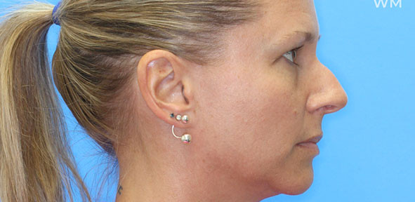 Rhinoplasty Patient 2 Before