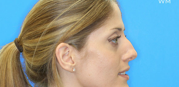 Rhinoplasty Patient 3 Before