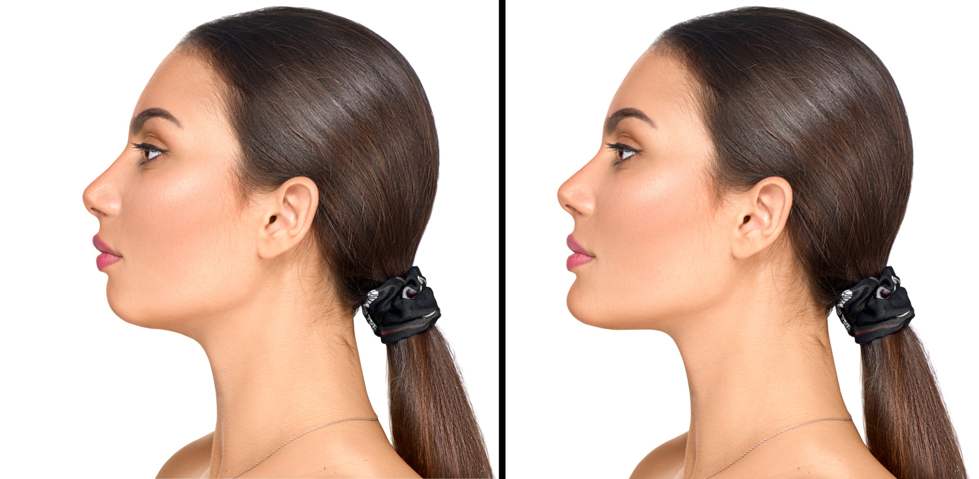 Before and after photo of a woman who underwent chin augmentation, showcasing a more defined and balanced profile