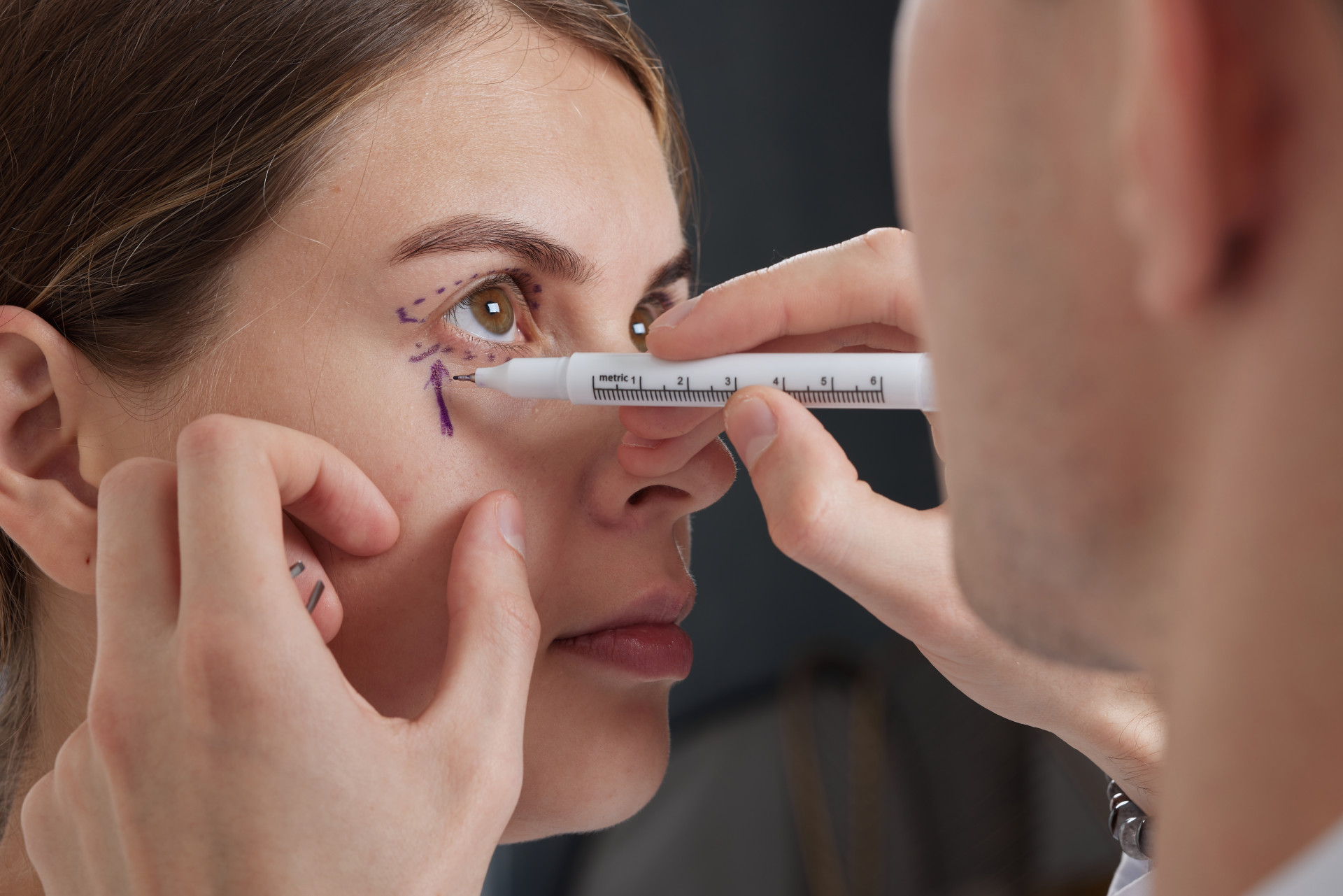 Close-up of a surgeon drawing precise lines on a woman's face, marking the areas for eye surgery